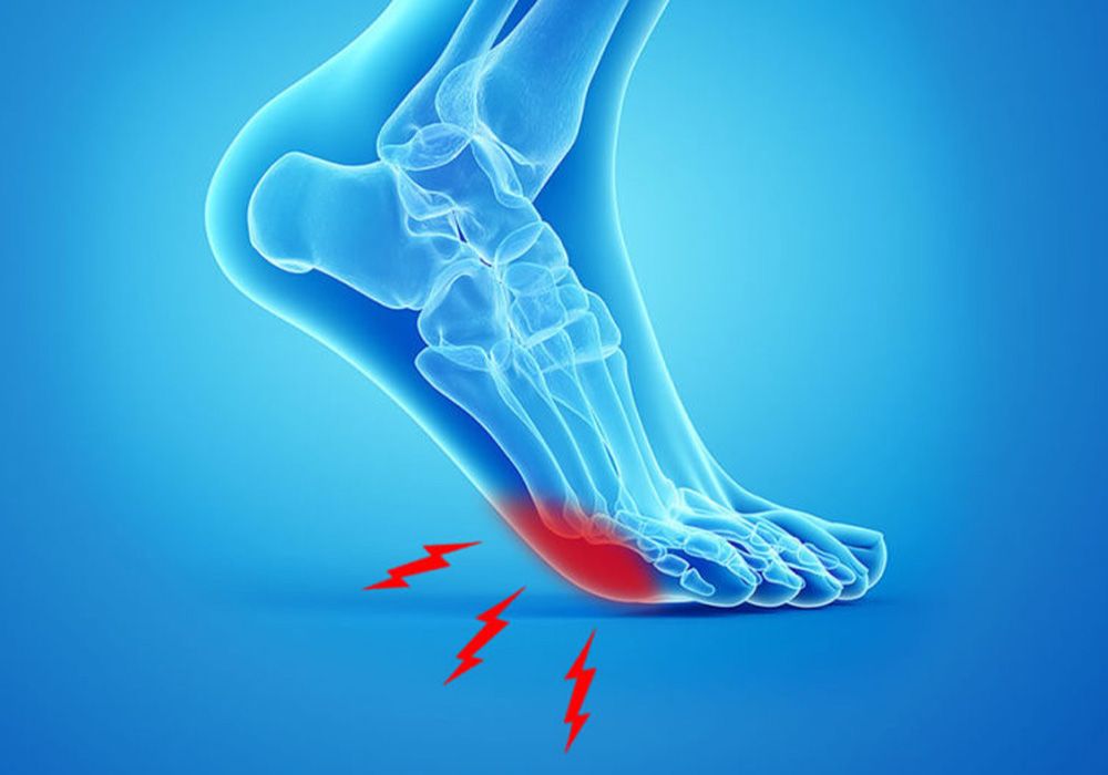 Illustration of the heel and arch affected by plantar fasciitis