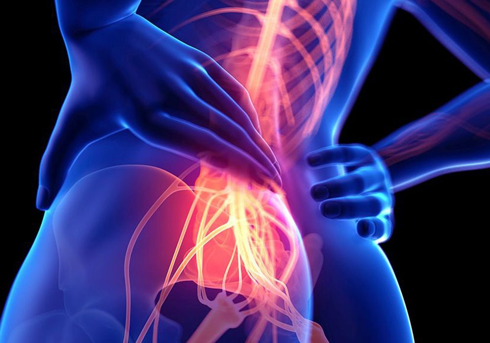 Illustration of the sciatic nerve and lower back highlighted in pain
