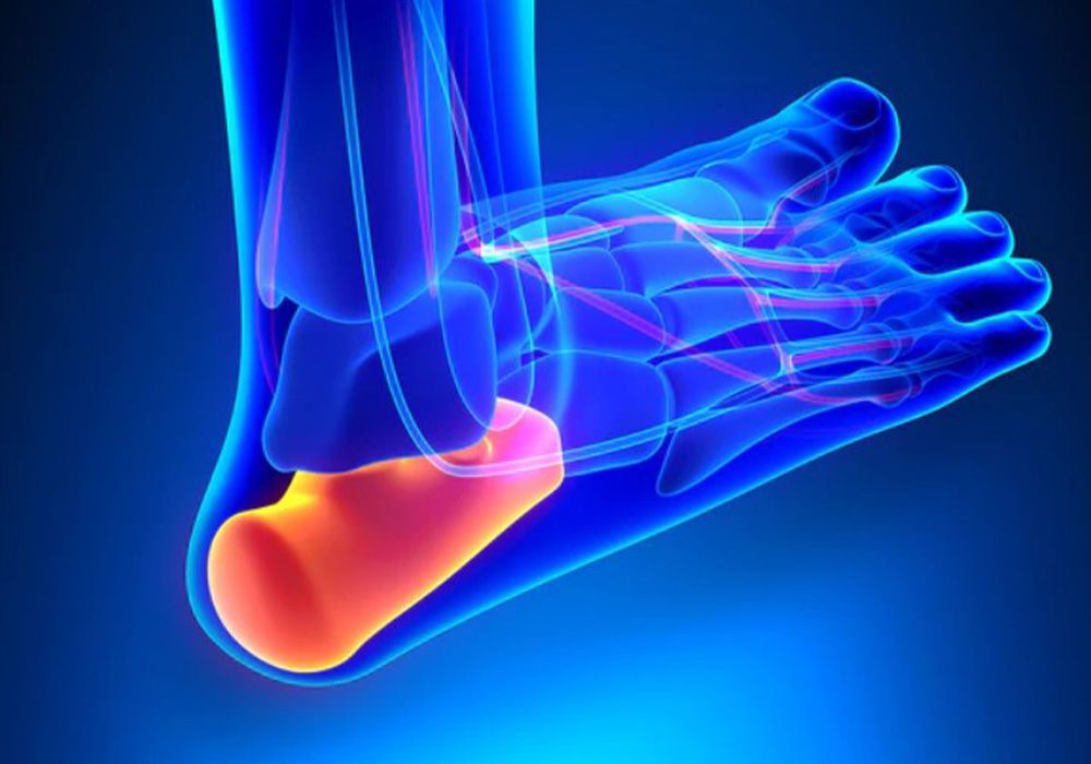 Illustration of nerves in the foot affected by peripheral neuropathy